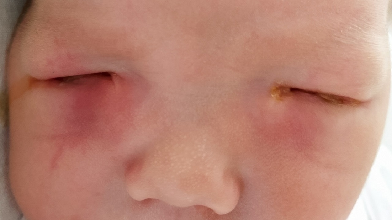 В Челябинске новорожденному спасли зрение, удалив из глаз огромные мешки со слизью