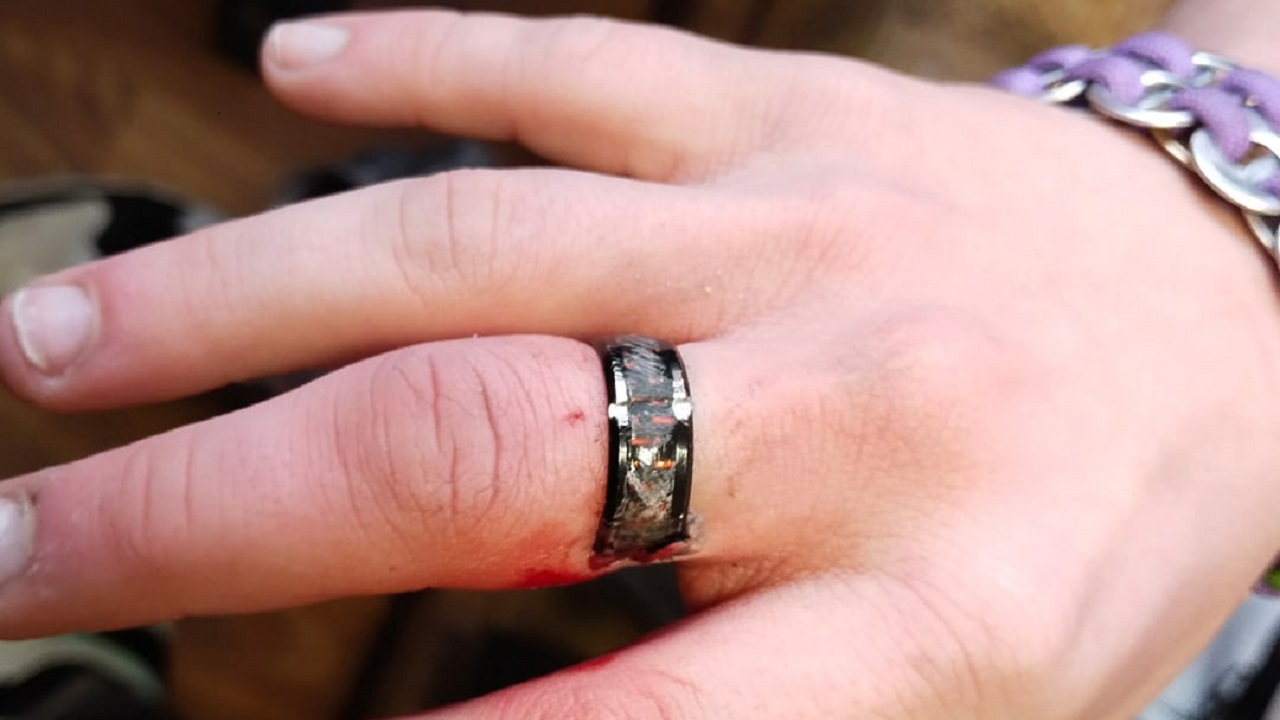 Красивая ловушка: спасатели помогли жителю Челябинской области снять кольцо с пальца