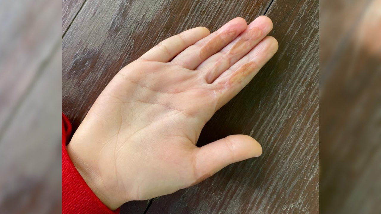 100 швов на пальцах: в Челябинске пересадили кожу на руку ребенку