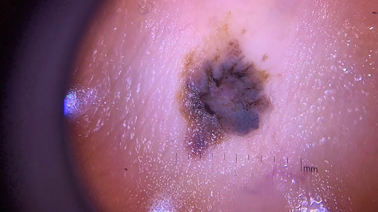 Жителям Челябинской области рассказали, какие родинки должны насторожить Жителям Челябинской области рассказали, какие родинки должны насторожить