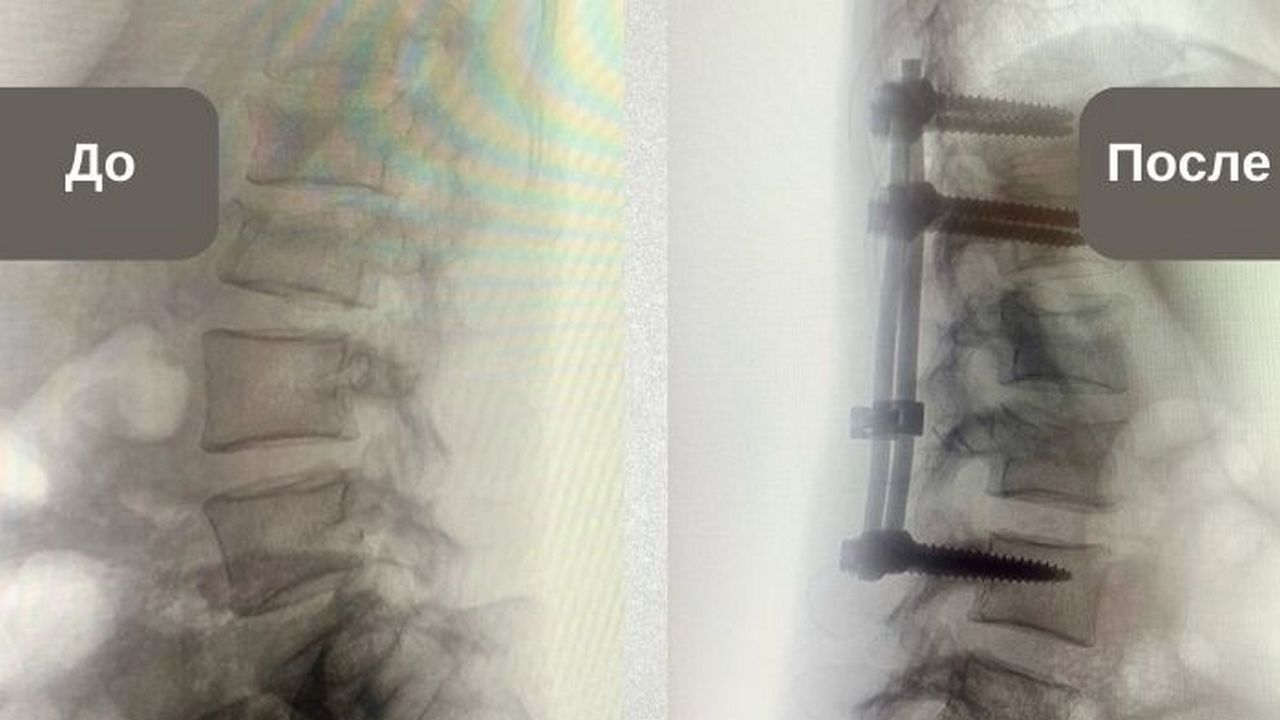 Врачи в Магнитогорске спасли женщину, которая сломала позвоночник после падения с 5 этажа