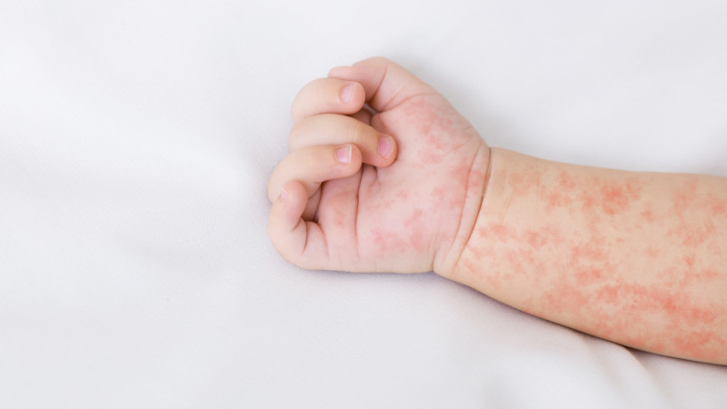 Впервые за несколько лет в Челябинской области выявили 2 случая заражения корью 