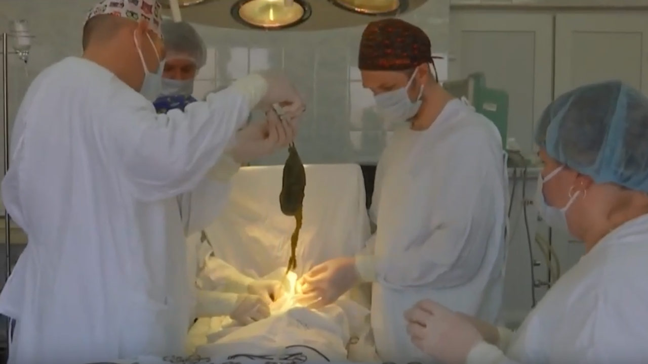 Полкилограмма волос достали из желудка подростка в Челябинской области