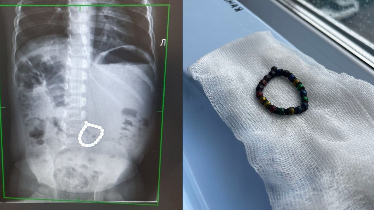 В Челябинской области двухлетний ребенок проглотил 20 магнитов