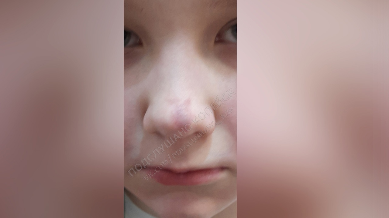 В Копейске ребенок обморозил нос, пока ждал автобус на остановке 