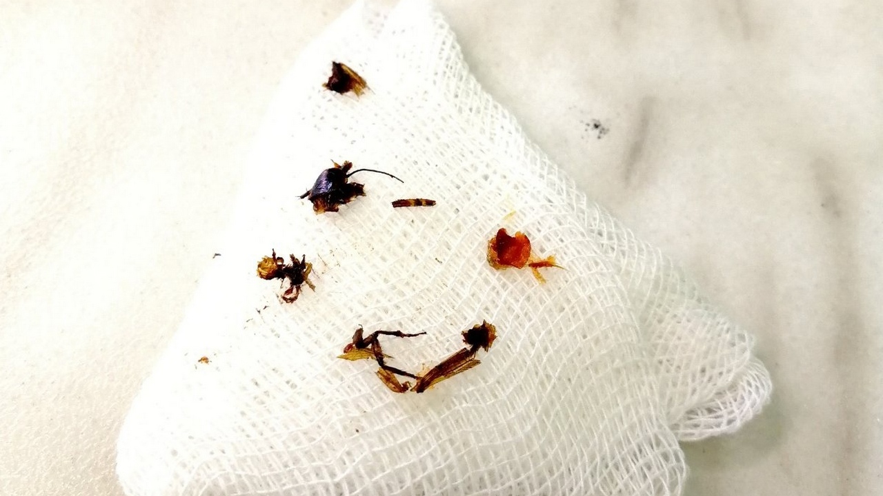 Мертвого таракана нашли в ухе двухлетнего ребенка в Челябинске