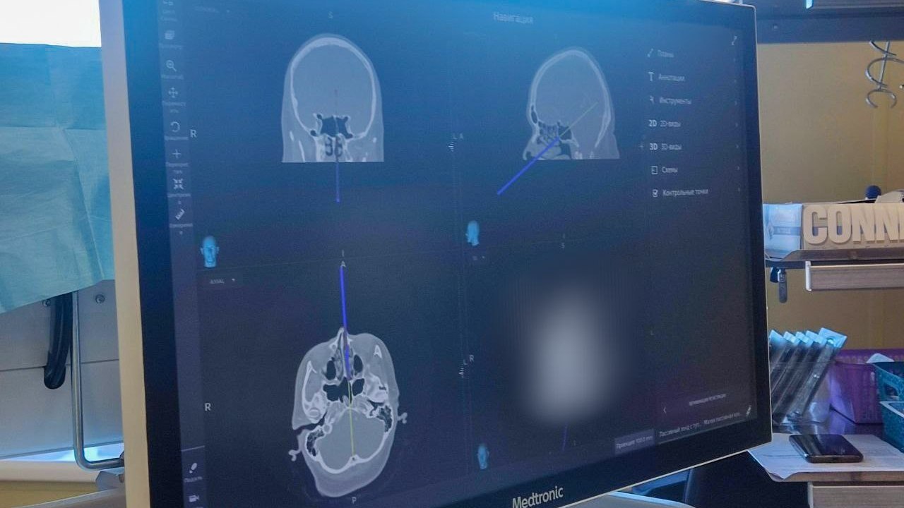 Челябинские врачи начали удалять опухоли мозга через проколы в носу