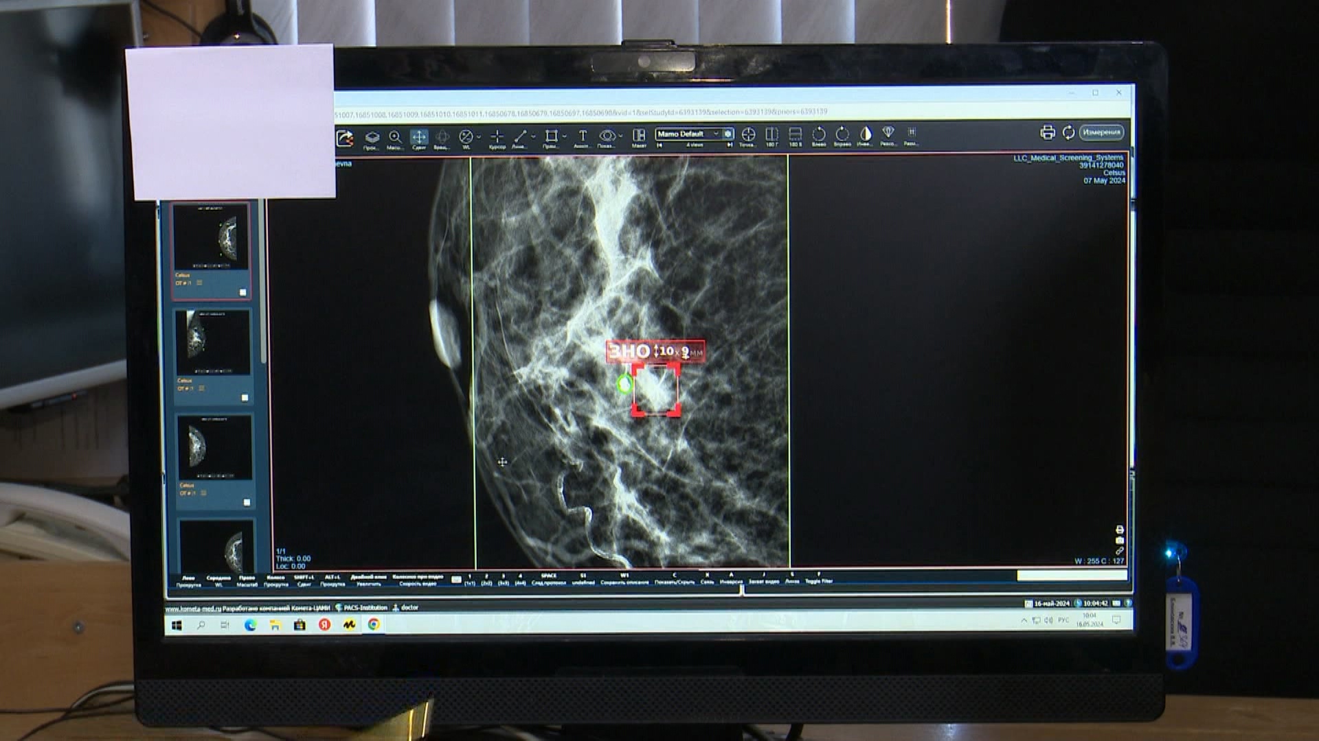 Новейший цифровой маммограф помогает врачам в Челябинске выявлять опухоли 