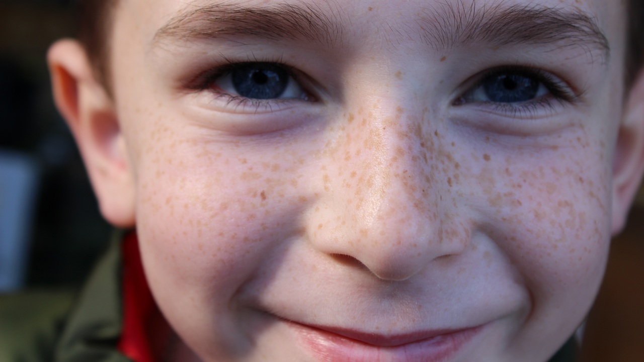 Врач из Магнитогорска назвала способы распознать опасные родинки у ребенка