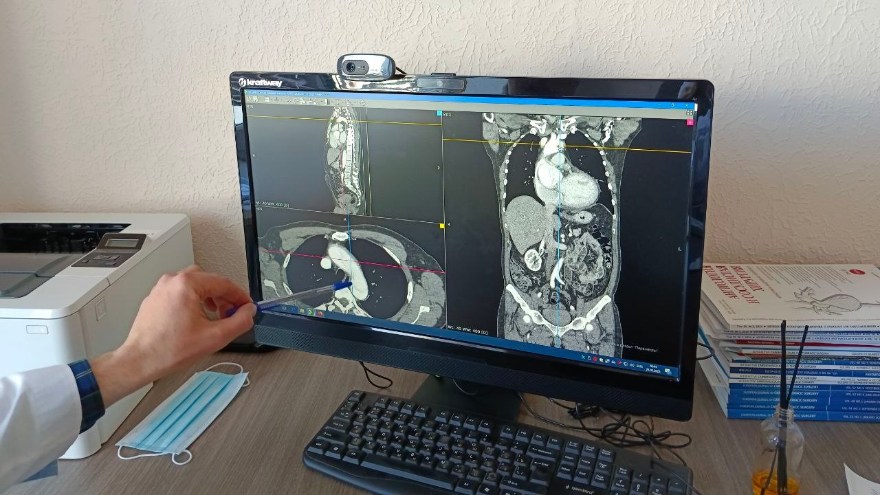 На грани смерти: врачи в Челябинске спасли двух пациентов с расслоением аорты