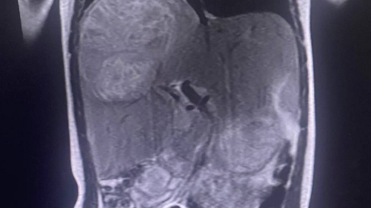 Хирурги из Челябинска спасли ребенка с огромным абсцессом печени Хирурги из Челябинска спасли ребенка с огромным абсцессом печени