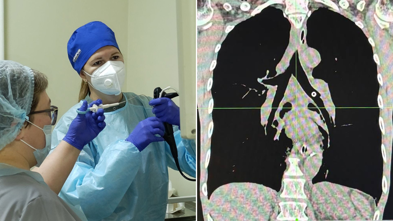 Протез упал в бронхи: в больнице Челябинска спасли мужчину с редким случаем Протез упал в бронхи: в больнице Челябинска спасли мужчину с редким случаем