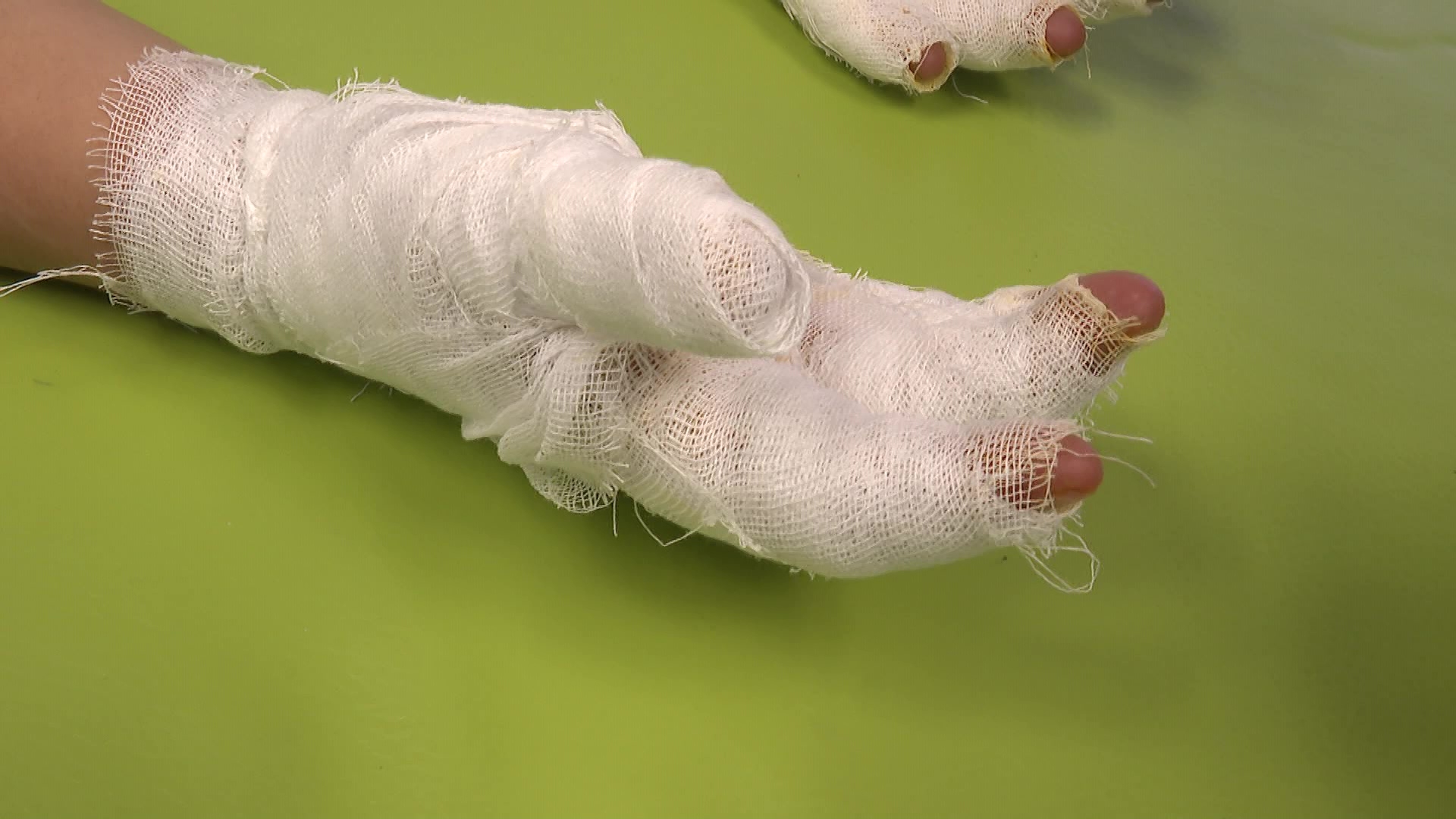 Обморожения и переломы: об опасностях зимних развлечений рассказали врачи из Челябинска Обморожения и переломы: об опасностях зимних развлечений рассказали врачи из Челябинска