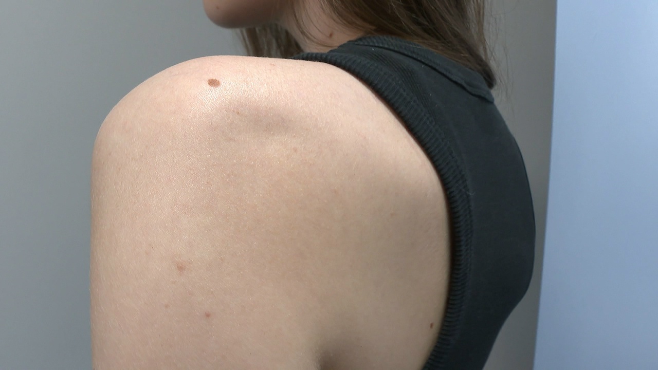 Как отличить родинку от меланомы: эксперты рассказали челябинцам, когда бить тревогу