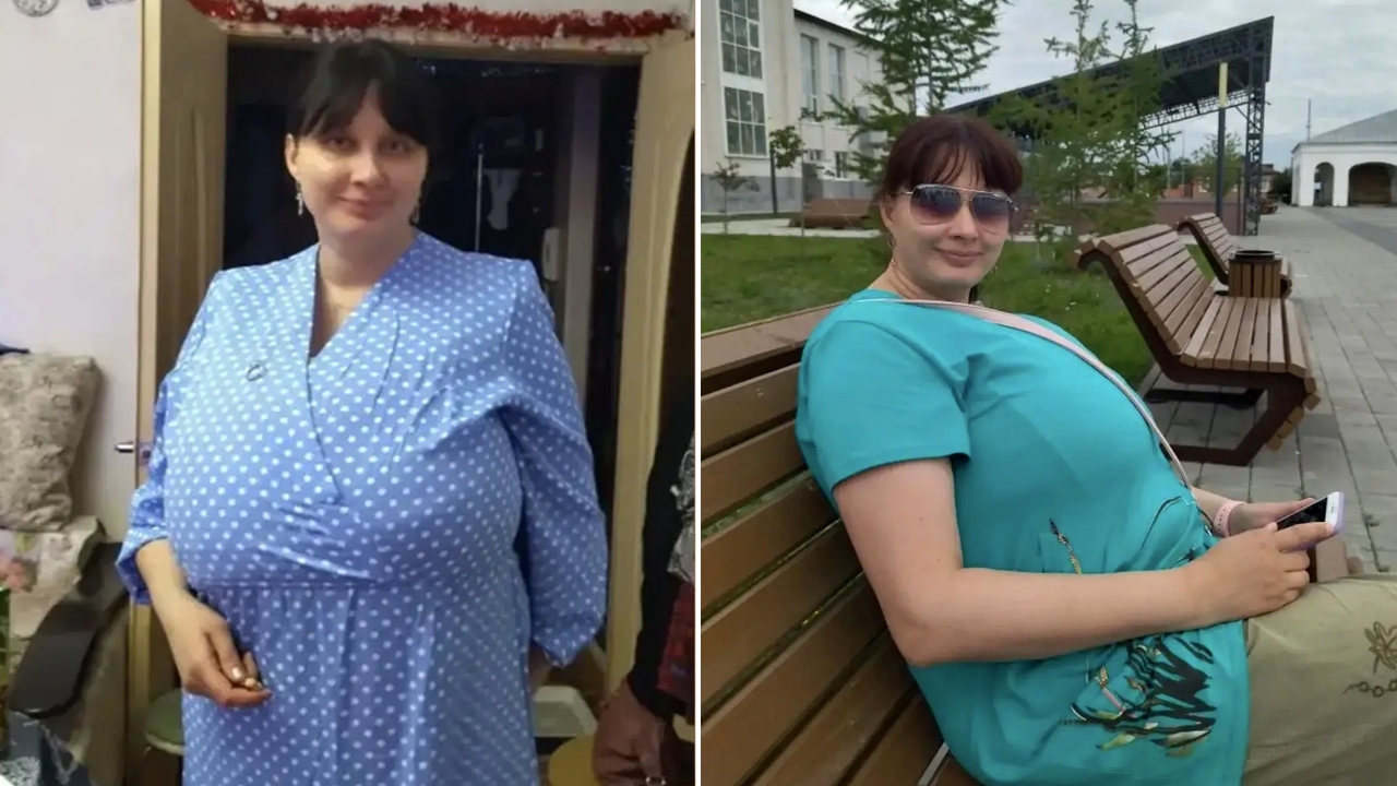 Не могла стоять: в Челябинске прооперировали пациентку с грудью 22-го размера