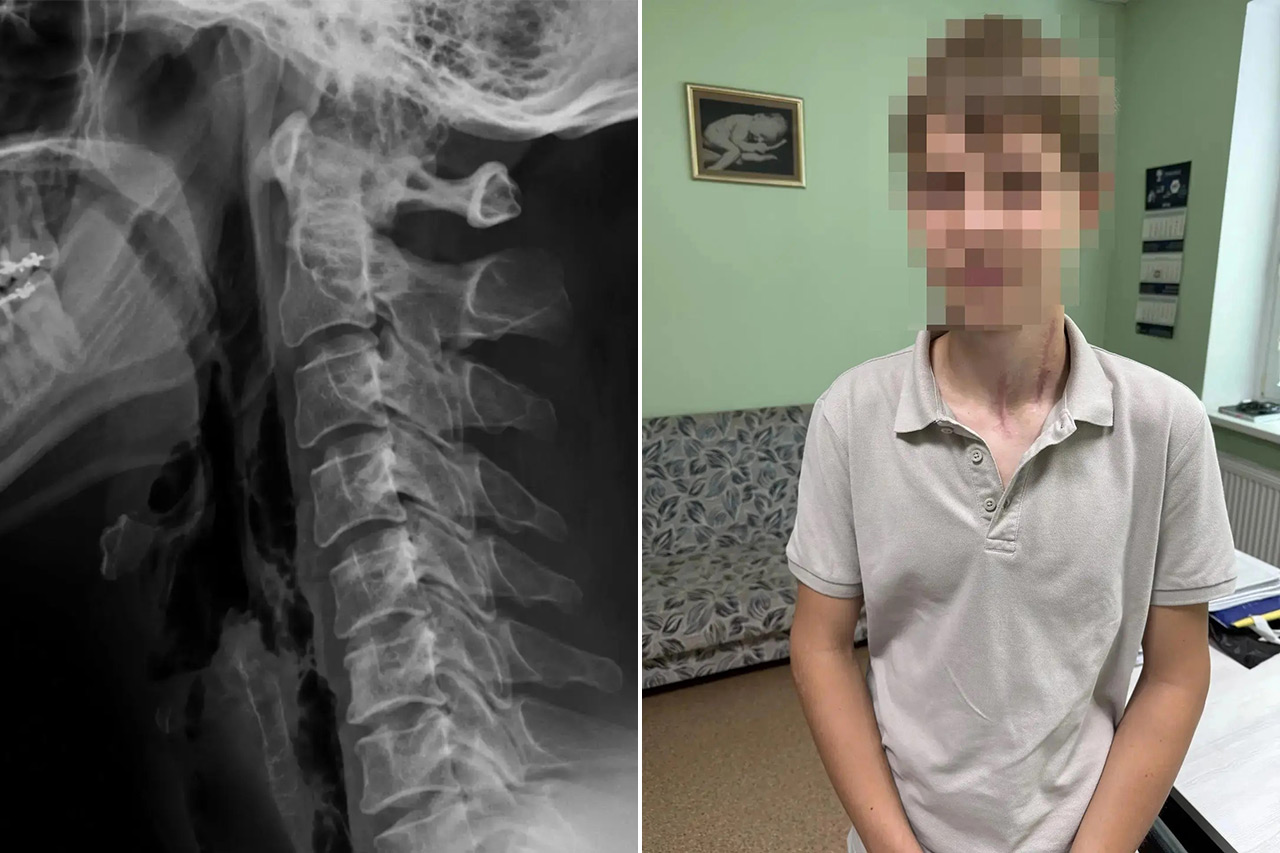 В Челябинске спасли подростка, которому разрезало шею проволокой В Челябинске спасли подростка, которому разрезало шею проволокой
